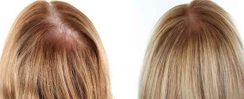 Hair Regrowth PRP Therapy