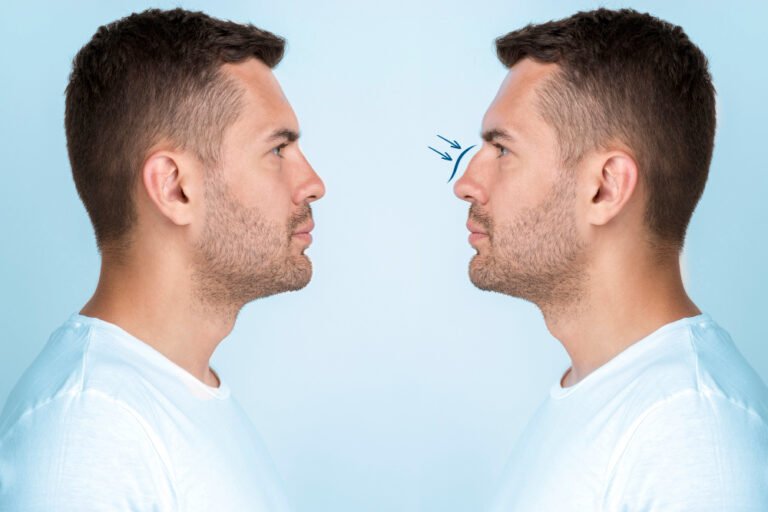 Bridge Augmentation for Men