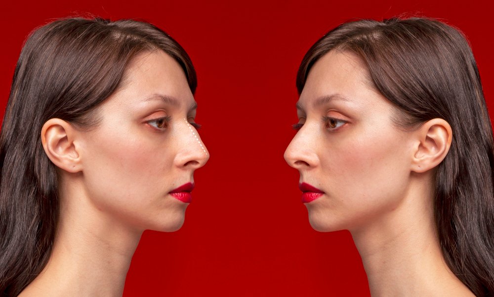 Angle Reduction Surgery
