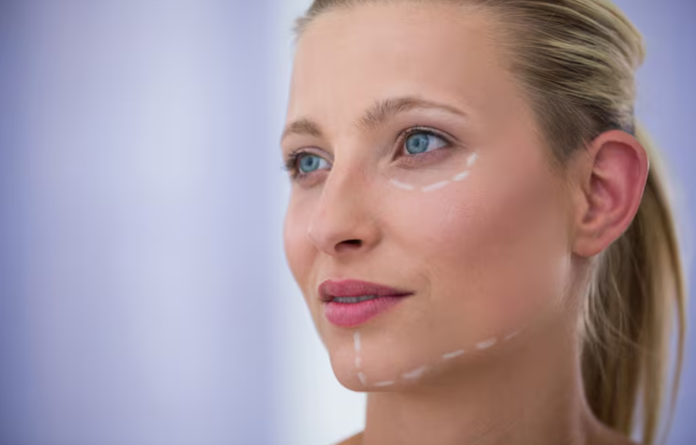 Transconjunctival Levator Advancement