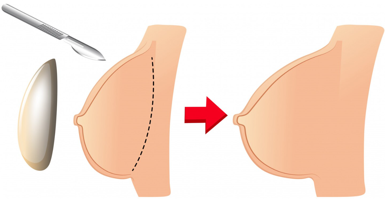 Pure Fat Transfer Breast Augmentation