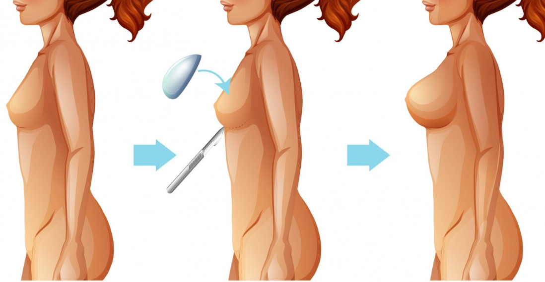 Autologous Fat Transfer Breast Augmentation