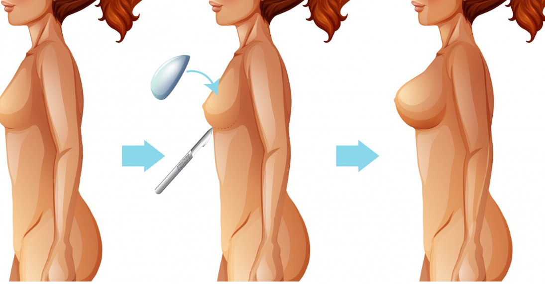 Topical Laser-Assisted Nipple Correction