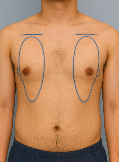 Chest BodyTite