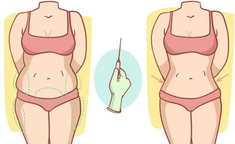 Partial Abdominoplasty