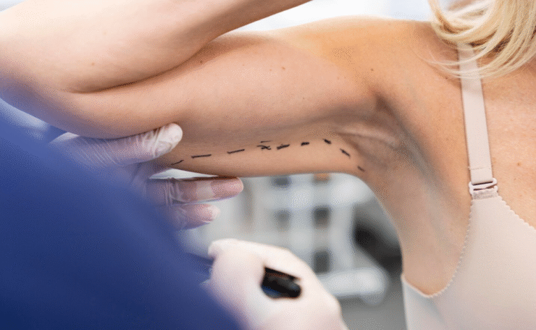 Posterior Arm Liposuction