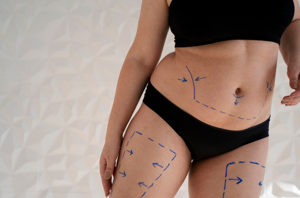 Inner Thigh Lift