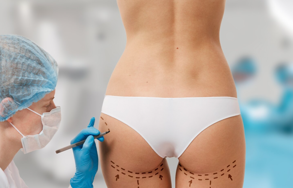 Buttock Contouring