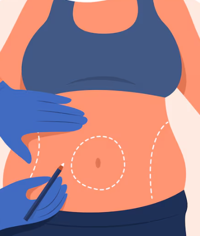 Tummy Lift