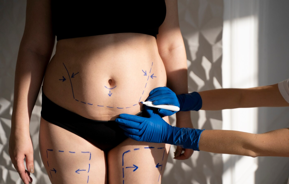 Hip Line Sculpting