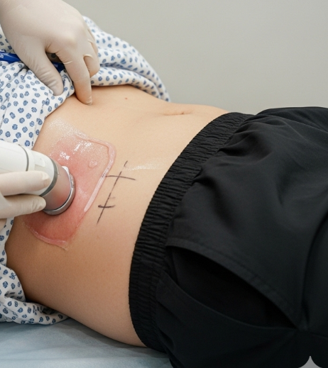 W-Shaped Umbilicoplasty