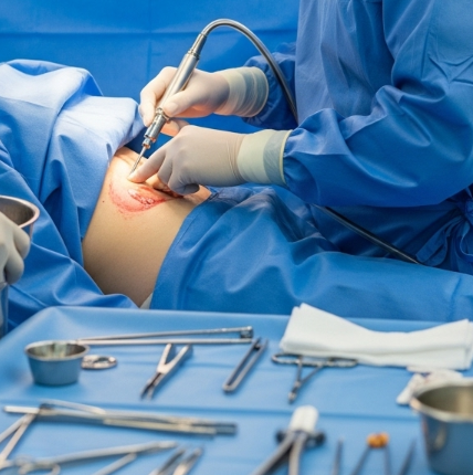 Flank Liposuction