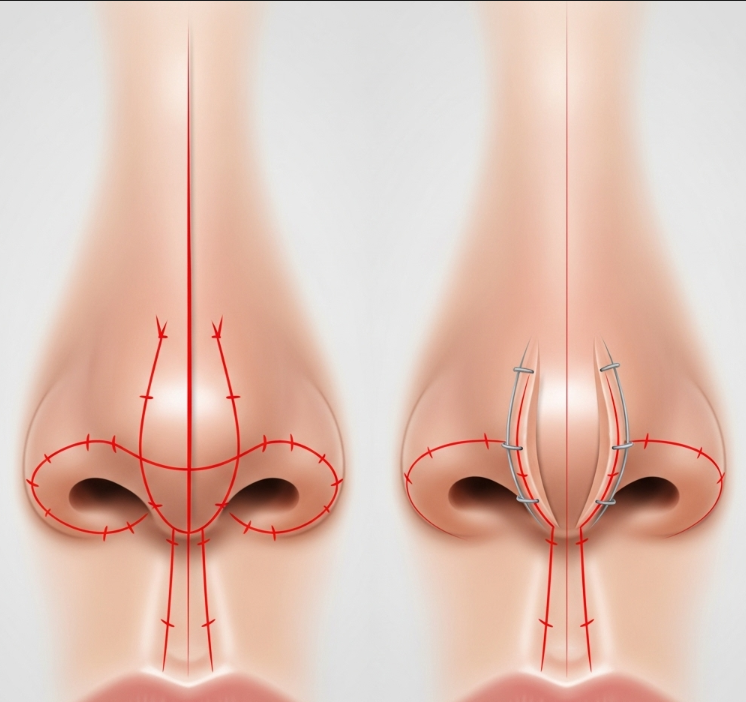 Wide Nostril Correction Surgery