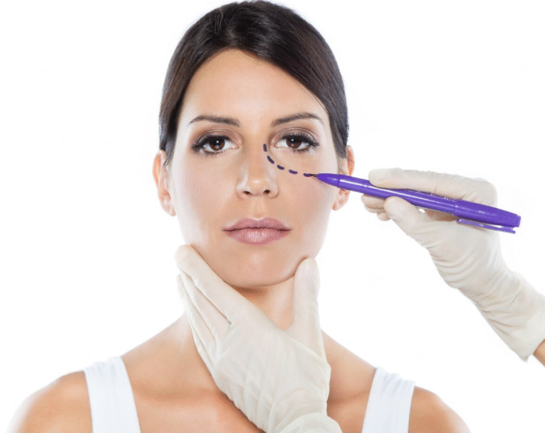 Z-Lateral Canthoplasty