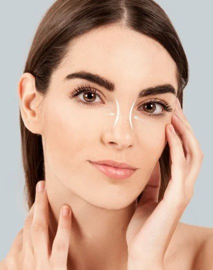 Vertical Canthoplasty