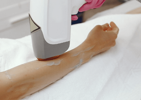 Nd:YAG Laser Hair Removal