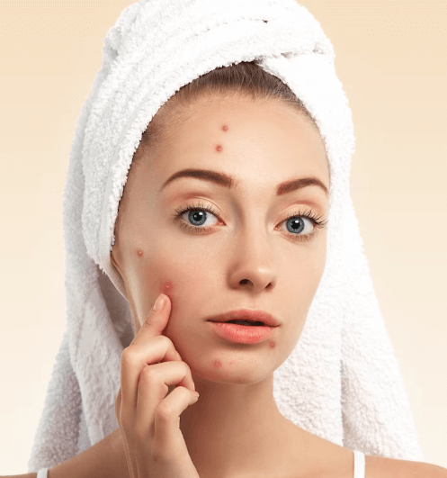 Purifying Acne Facial