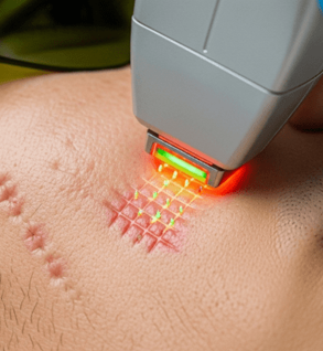 Acne Scar CO2 Resurfacing