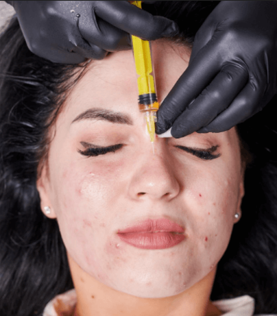 Acne Scar PRP Facial