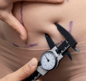 Autologous Fat Grafting with Subcision