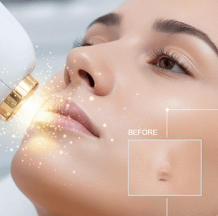 BB Laser