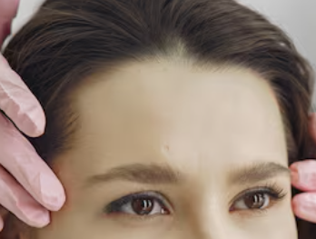 Balanced Forehead Volume Enhancement