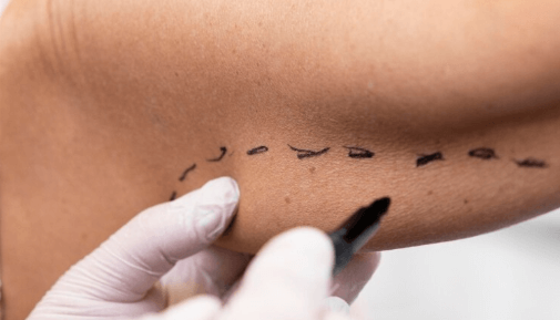 Underarm InMode Tightening