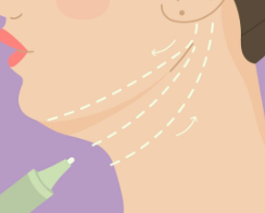Botox Neck Line Reduction