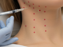 Botox for Platysma Bands