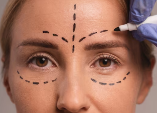 Botox for Temporal Lines