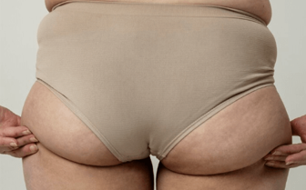 Buttock BodyTite Lift