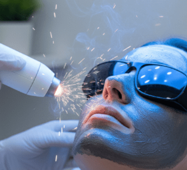 Carbon Laser Peel with Blue Light