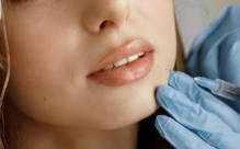 Cheek Augmentation