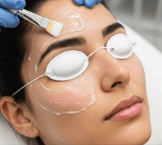 Chemical Peel