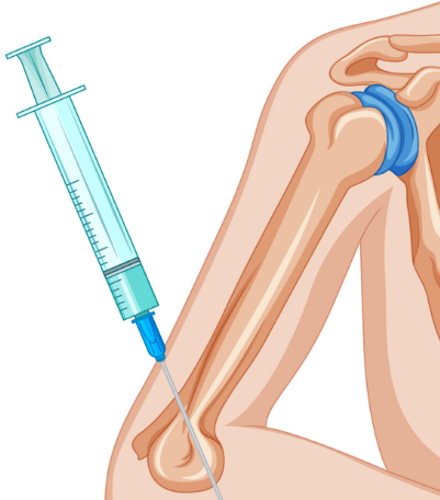 Cortisone Injection