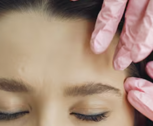 Defined Forehead Profile Fillers