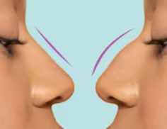 Elegant Nose Profile Correction