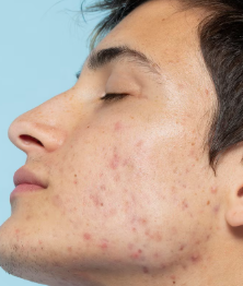 Enlarged Pore Fraxel