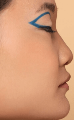 Flat Nose Bridge Correction Fillers