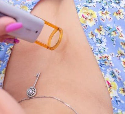 Fractional CO₂ Laser for Stretch Marks