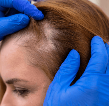 Hair Density Boost Exosome Therapy