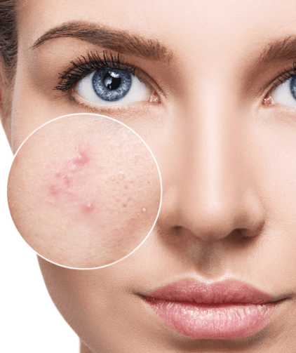 Intensive Acne Repair Facial