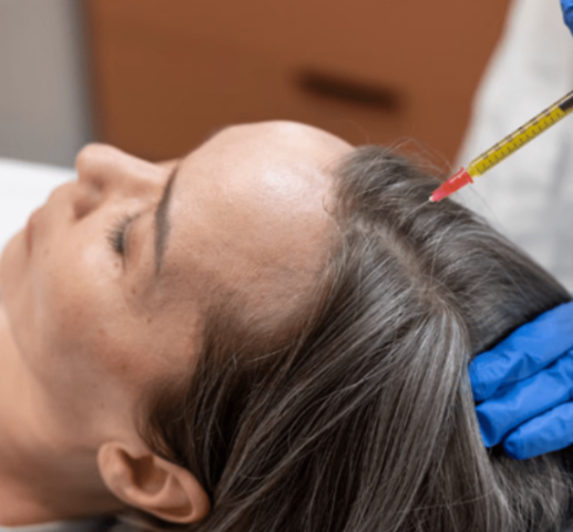 Intensive Scalp Mesotherapy