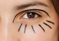 Korean Under-Eye Volume Restoration