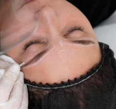 Smooth Forehead Volume Restoration