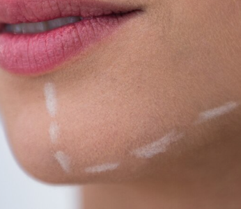 Lower Face Contouring with Fillers