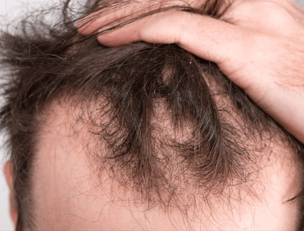 Male Pattern Baldness PRP Treatment