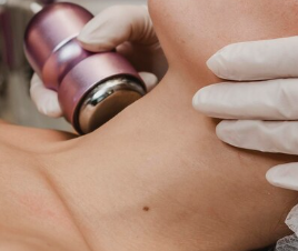 Microneedling RF Neck Tightening