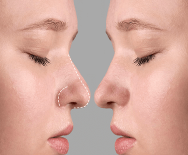 Midline Nose Sculpting Fillers