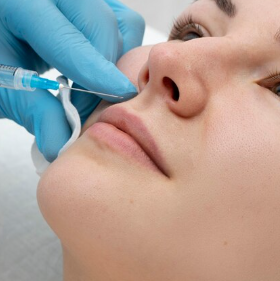 Nasolabial Fold Softening